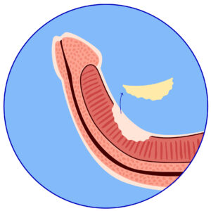 Illustrations - Male Fertility and Peyronie's Clinic