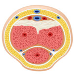 cross section of a penis with Peyronie’s disease-01